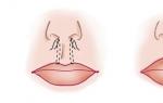 बुलहॉर्न सर्जरी में ऊपरी होंठ की प्रभावी प्लास्टिक सर्जरी