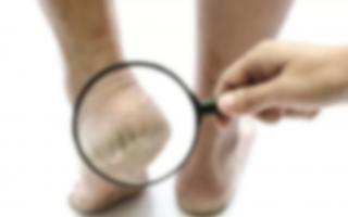 การทาส้นเท้าด้วยไอโอดีนมีประโยชน์หรือไม่ และเหตุใดคุณจึงใช้ตาข่ายไอโอดีน