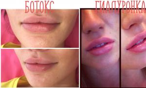 Botox za usne - zašto je ovaj postupak najteži u terapiji botulinom?