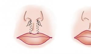 Effective plastic surgery of the upper lip in bullhorn surgery