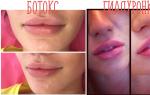 Ботокс губ — почему эта процедура самая сложная в ботулотерапии?